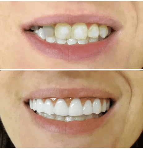 Dentadura Universal NewSmile Ajustável, Discreta e Confortável - Kit Prótese Dental Completa - Compre 1 e Leve 2